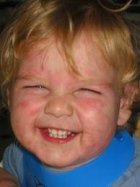 Know more about Facial Hives 