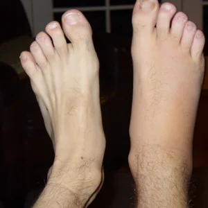 Broken fibula Vs. normal