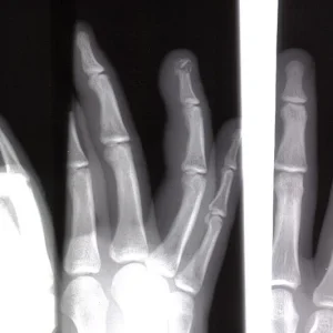 Shattered finger tip