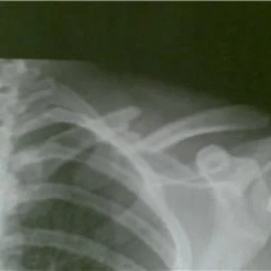 Broken collarbone.