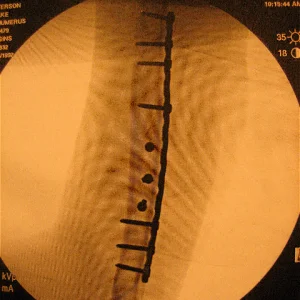 10 inch plate 10 screws