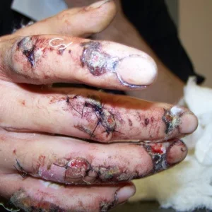 My hand one week after accident