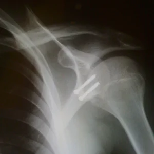 I fell.. and had surgery