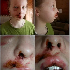 4 days after headplant