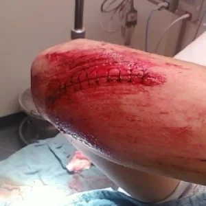 Long boarding crash