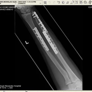 Broken arm