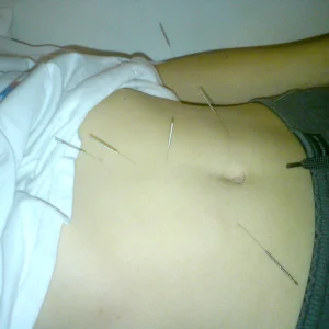 Acupunkture