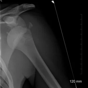 Shoulder x ray