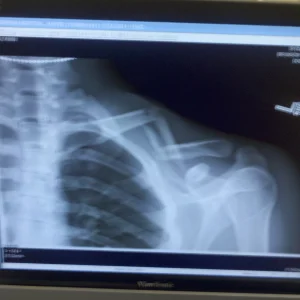My collar bone in 4 pieces.