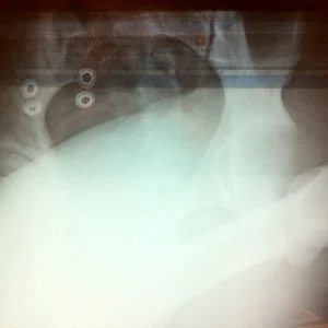 Dislocated hip