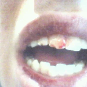 Broken Teeth