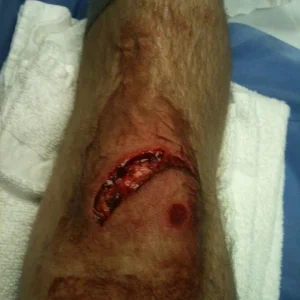 Down flat down, 32 stitches