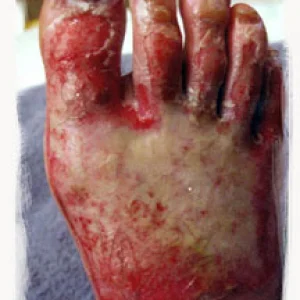 Dirty Matt Brogan's foot after he got his cast off!!!!