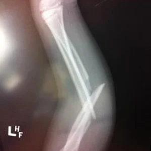 Compound fractured forearm