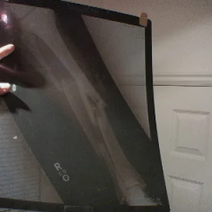 it's my broken leg from 2002 season