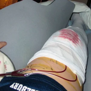 now THIS is a knee surgery..