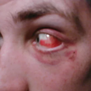 My latest eye injury.