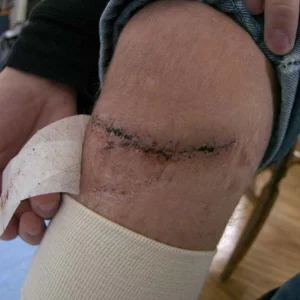 After i had my stitches removed! see the other two pics aswell, before and with stitches :)