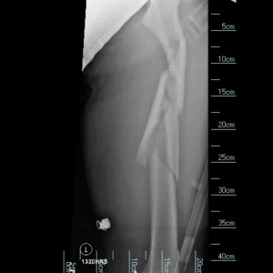 Broken Femur