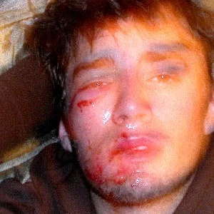 Me after coming up a little short on a back flip and breaking my cheak bone