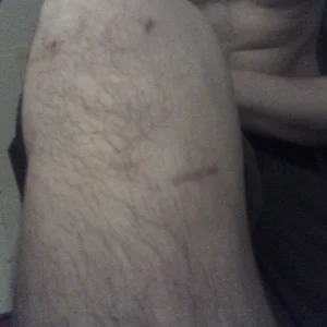 Best ACL surgery ever!