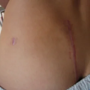 andres pimp pelvis surgery scar