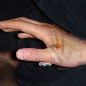 Post thumb surgery