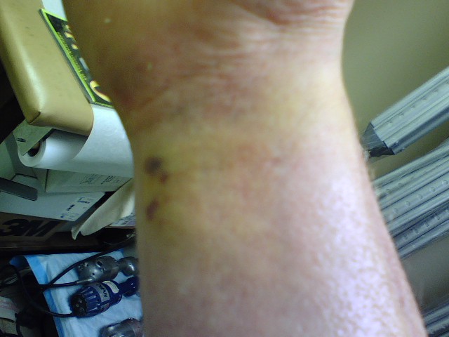 2 1/2 weeks after breaking wrist