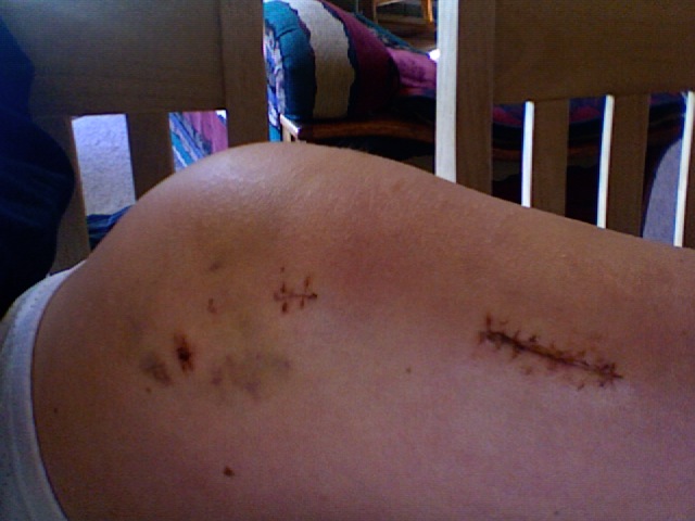 2.5 weeks after surgery