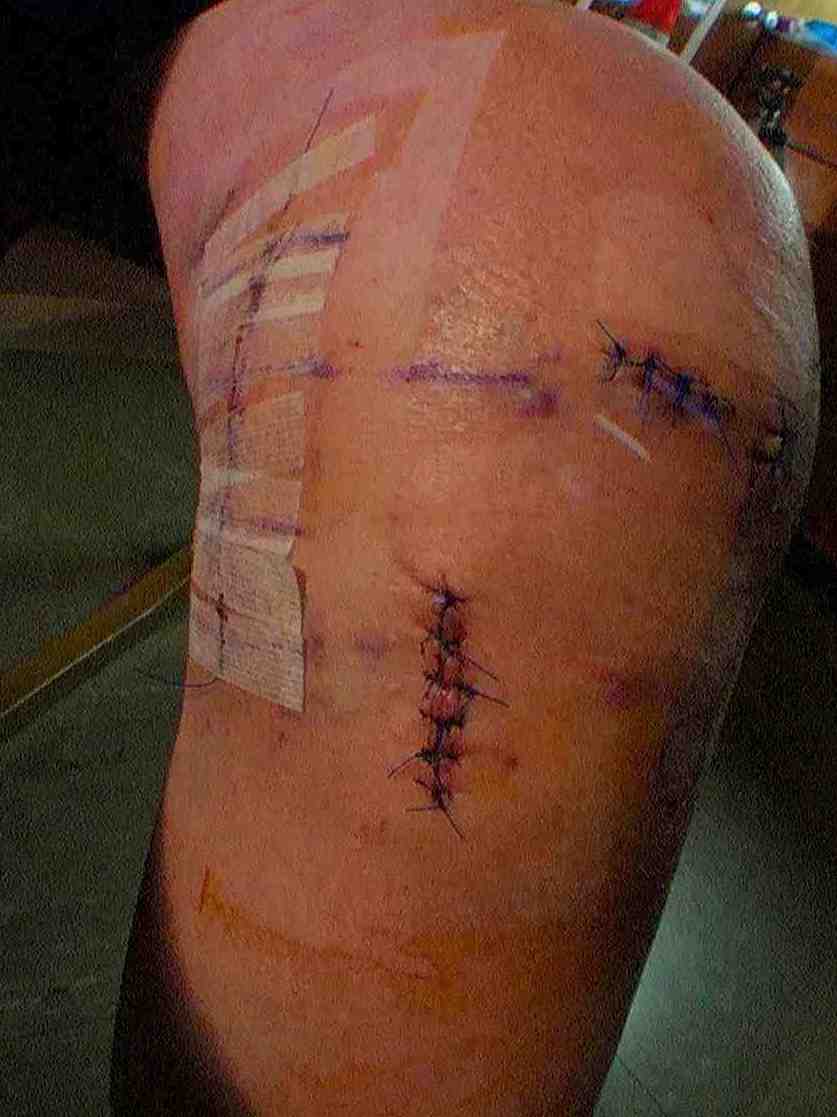 2nd torn acl and torn meniscus