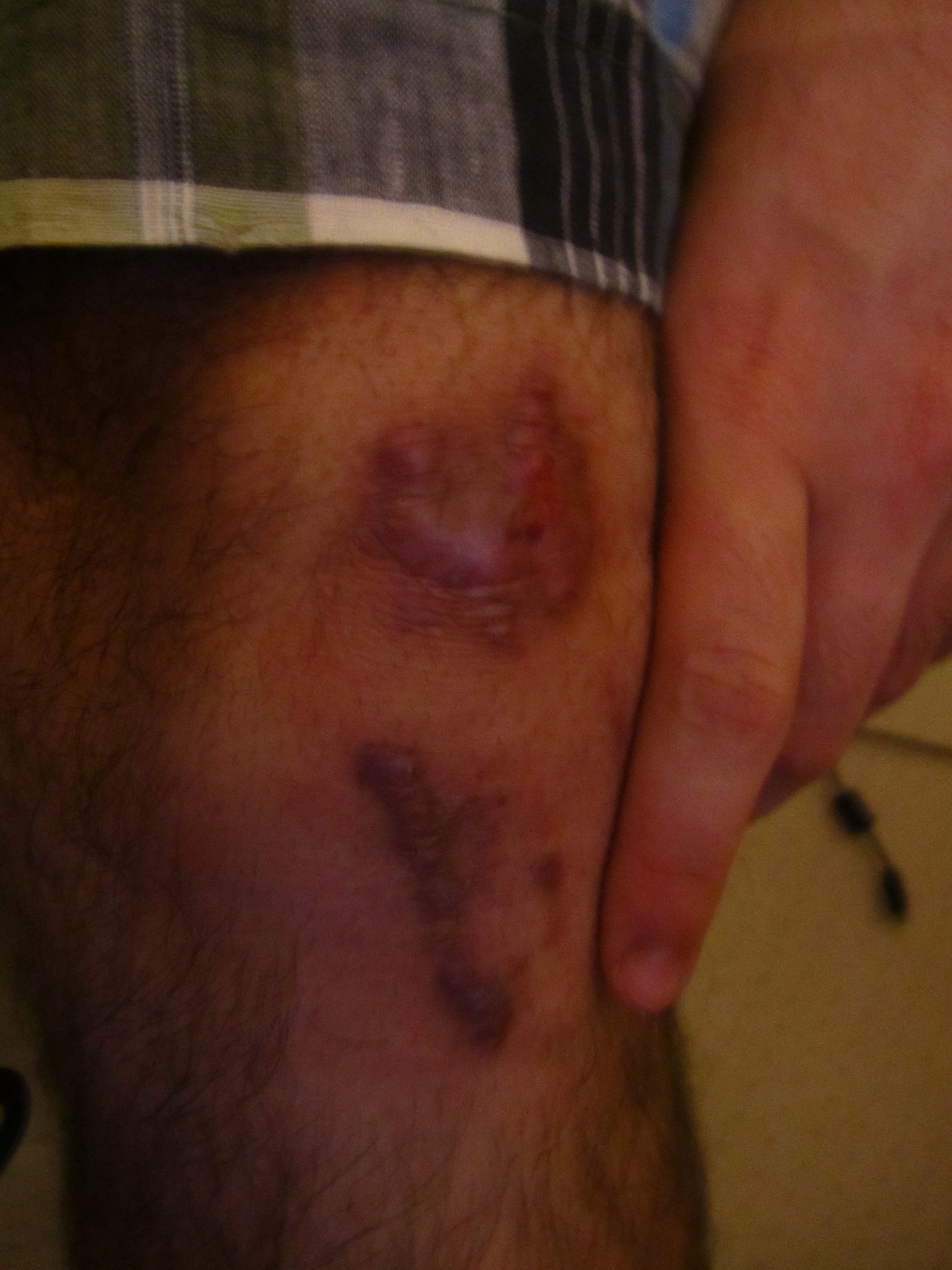 4 months after. scar.