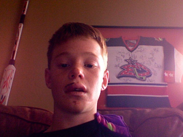 A couple days after i fell