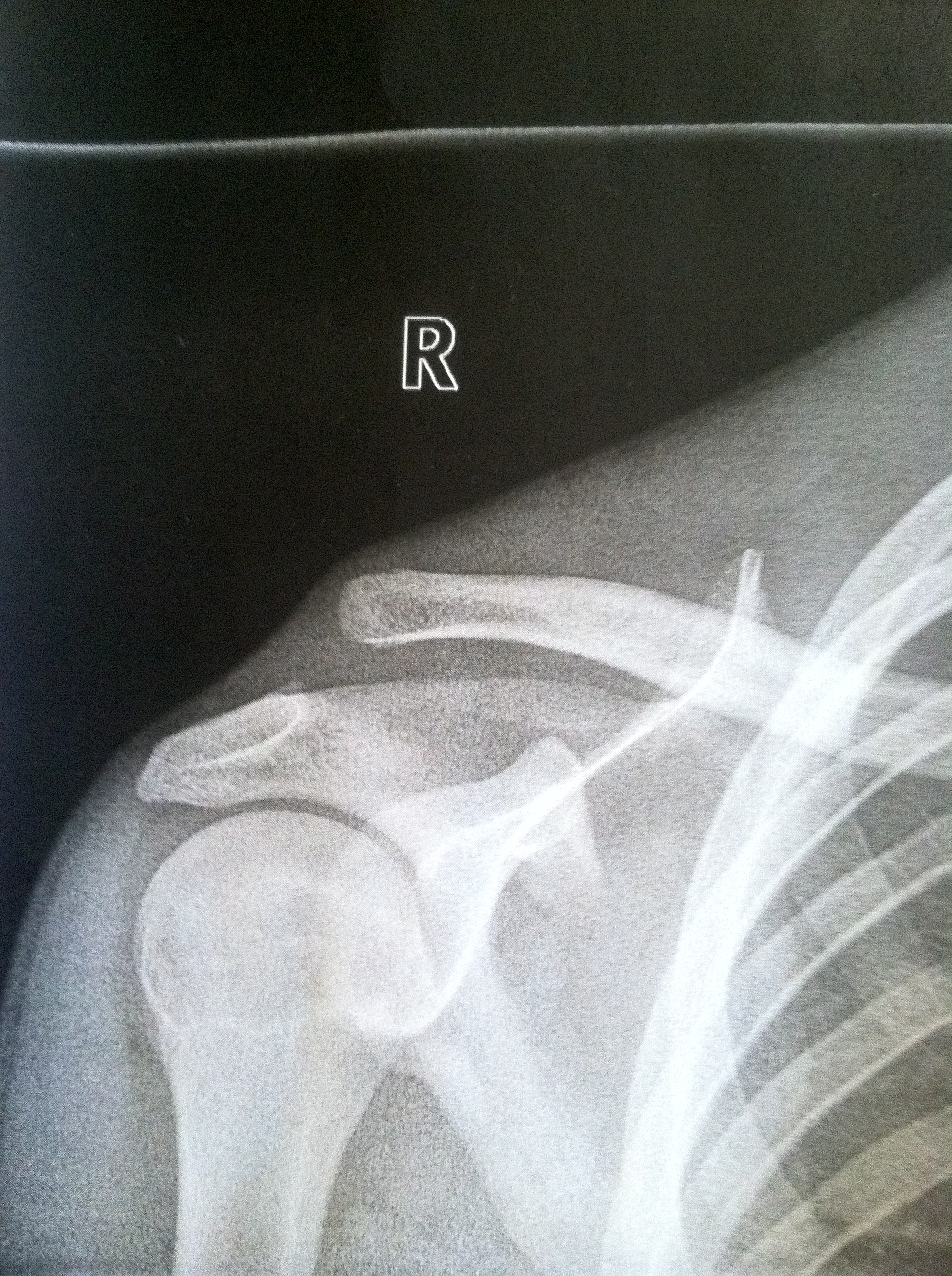 AC joint separation 
