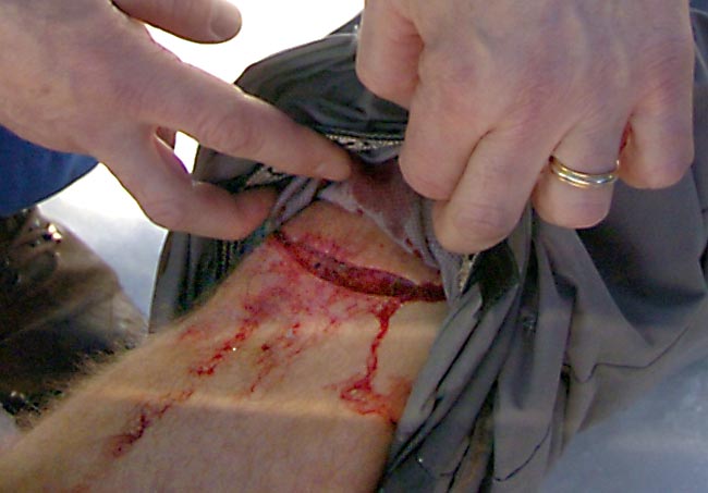 After a D-spin7 crash :) 16 stitches