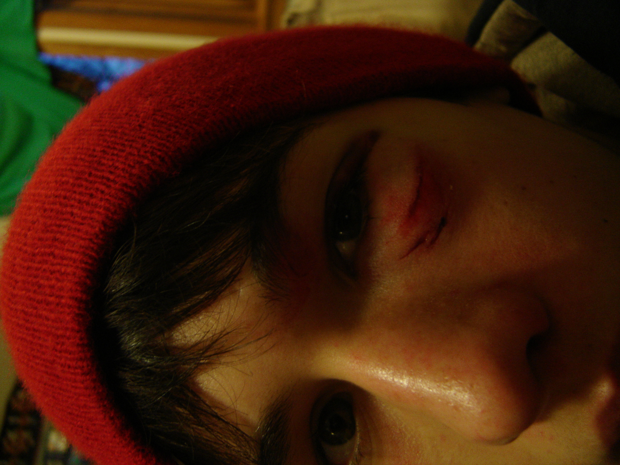 After a ski jump gone wrong