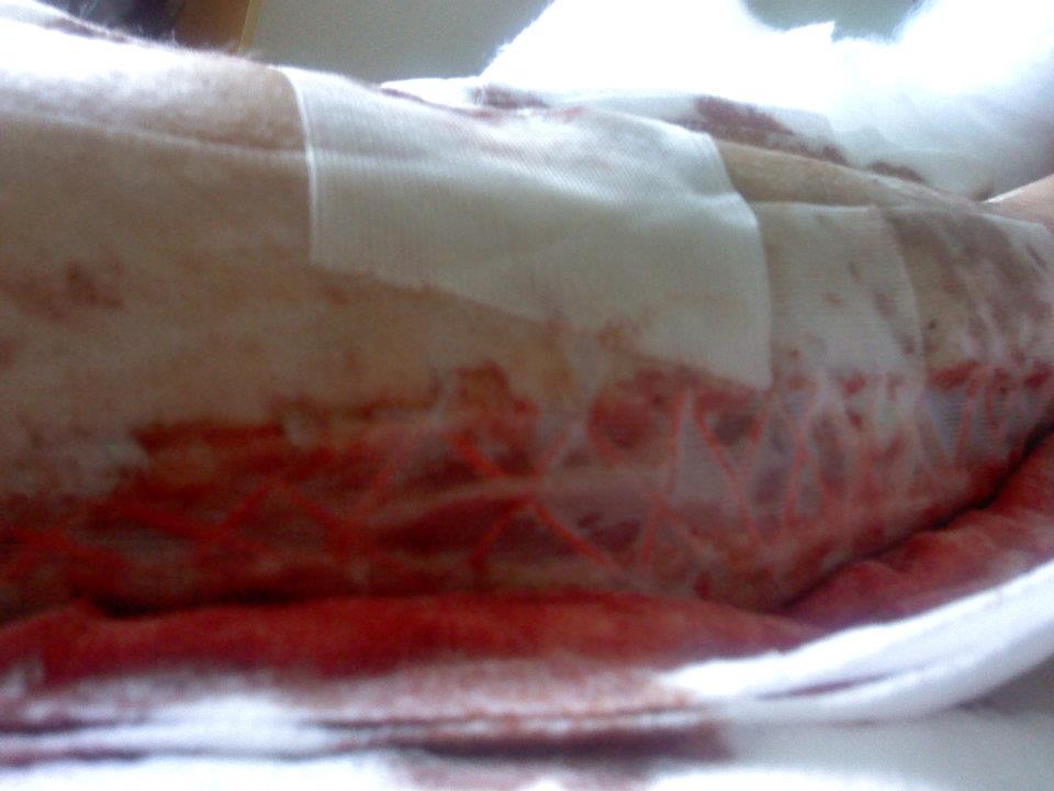 after damage from this...http://www.newschoolers.com/watch/389089.0/broken-leg?t=2