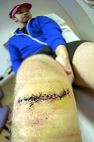 after i got my stitches done! also see other pics before and after stitches!