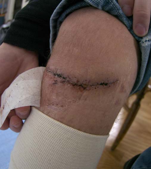 After i had my stitches removed! see the other two pics aswell, before and with stitches :)