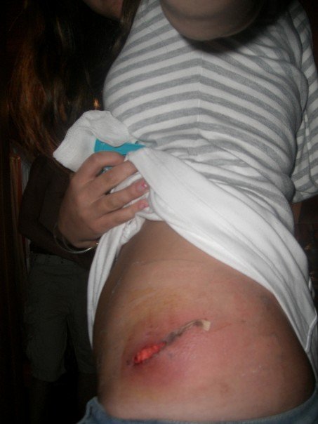 After surgery on my side