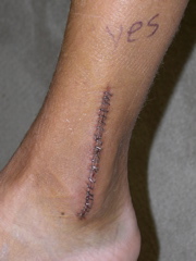 After the 2nd surgery