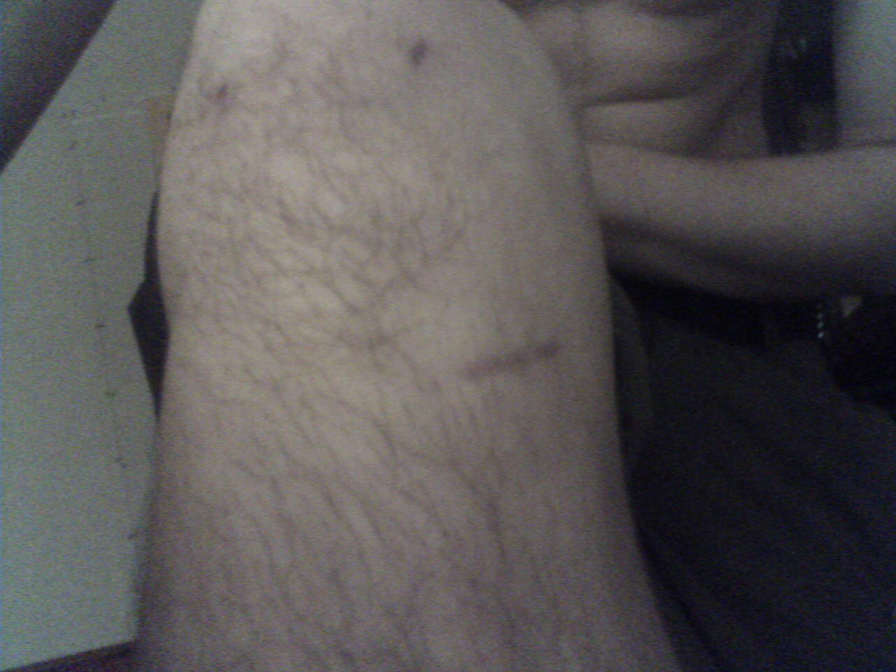 Best ACL surgery ever!