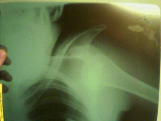 Blown out shoulder