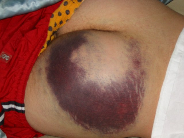 Brandon's ass after landing on it...OWWW