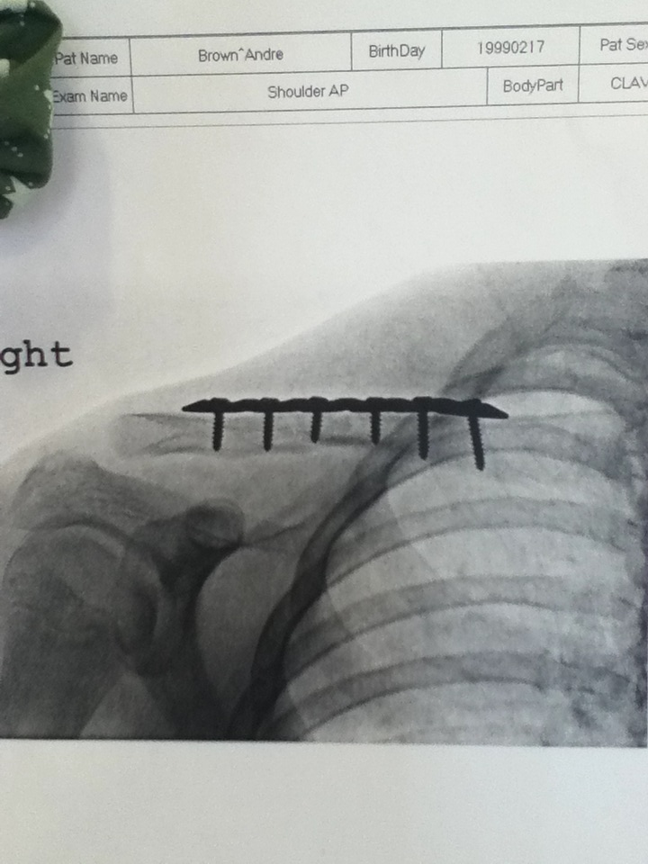 Broke my Collarbone