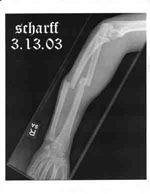 broken arm and wrist