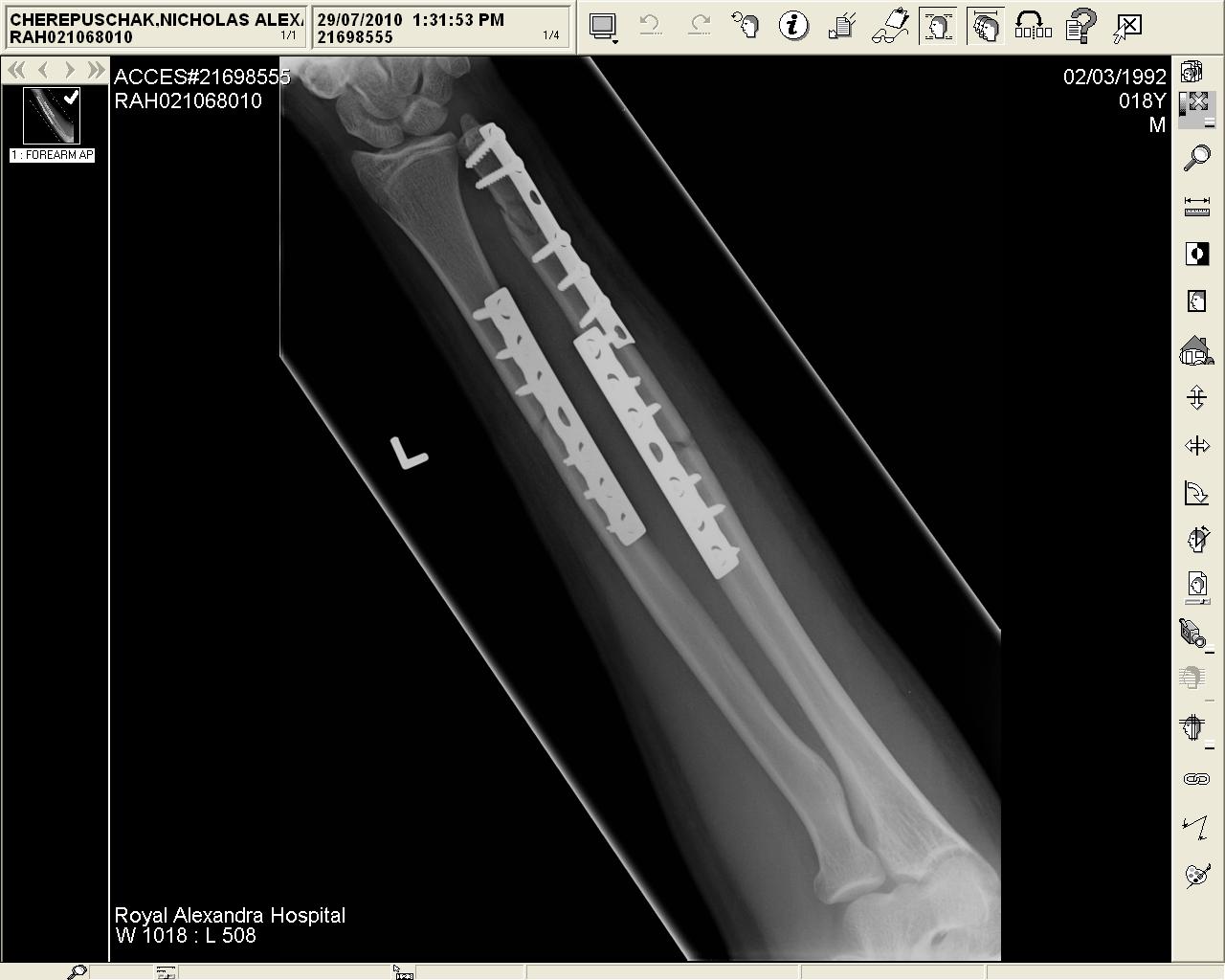 Broken arm