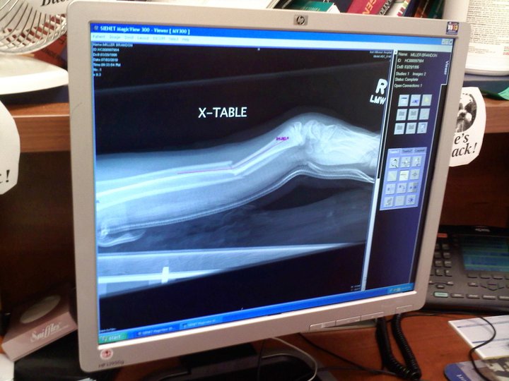 Broken Arm