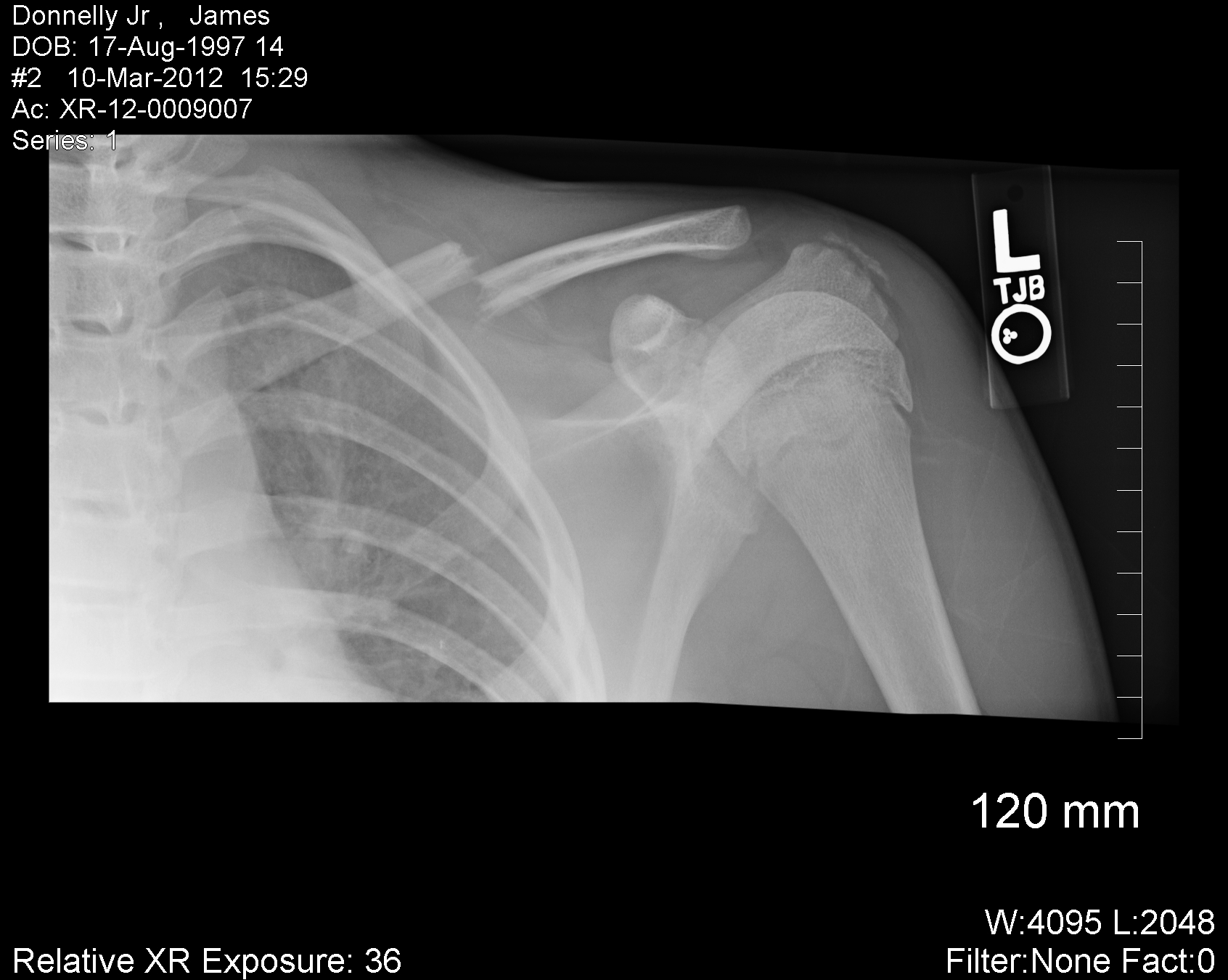 Broken Collar Bone