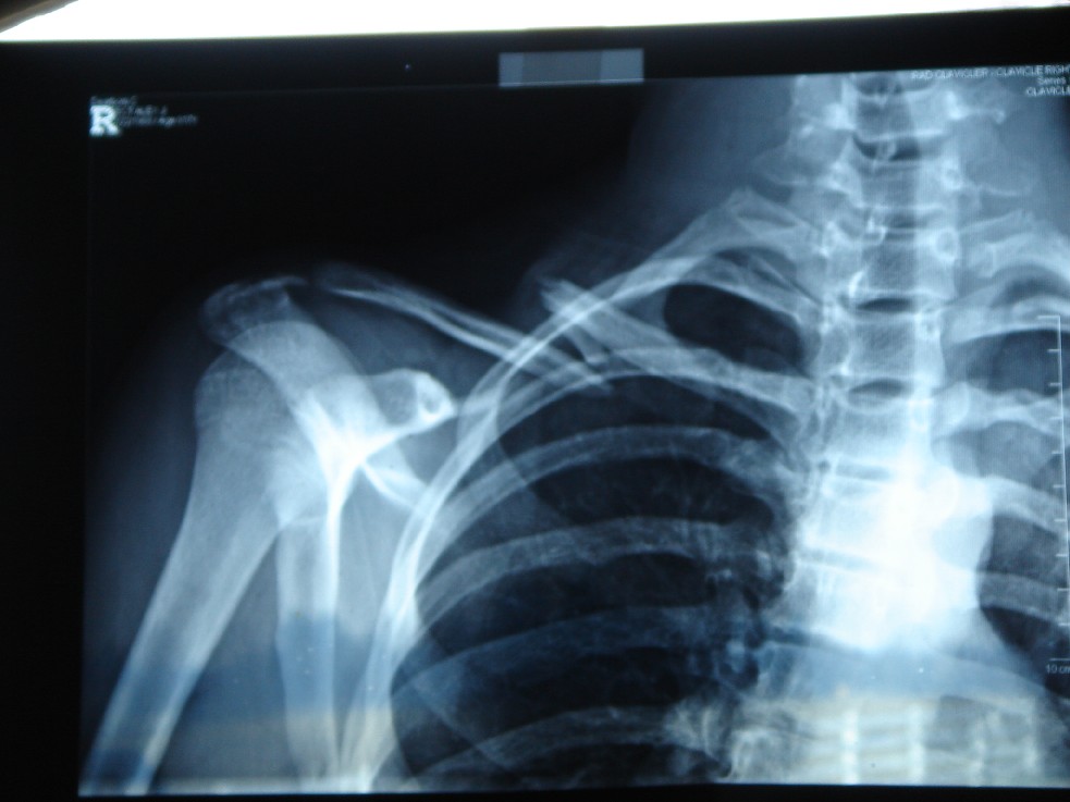 broken collar bone