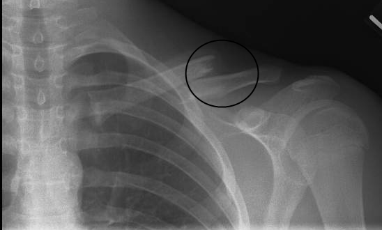 Broken Collarbone